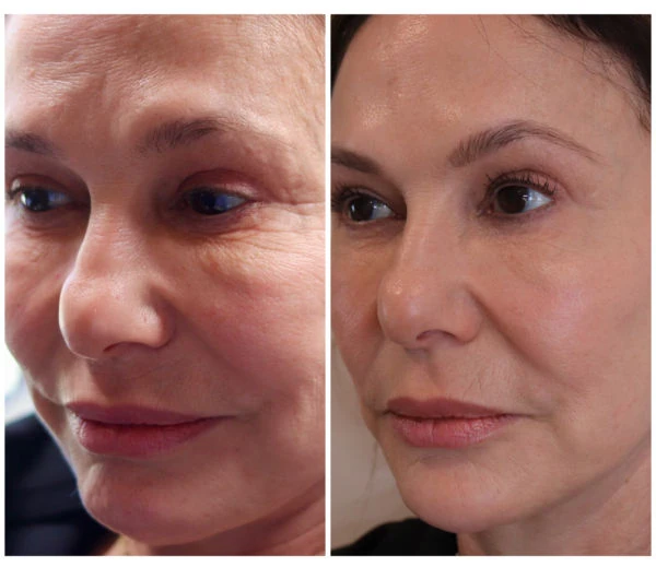Emerge Aesthetics Before & After Full Face Neurotoxin