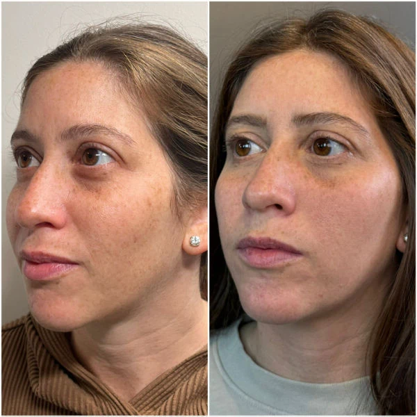 Emerge Aesthetics Before & After 1 session of CO2 Laser