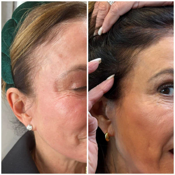 Emerge Aesthetics Before & After Woman's Hair Restoration