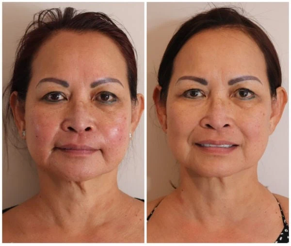 Emerge Aesthetics Before & After Sculptra