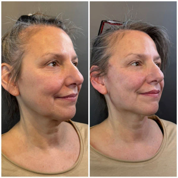 Emerge Aesthetics Before & After Threads Cheek Lift and Neck Lift