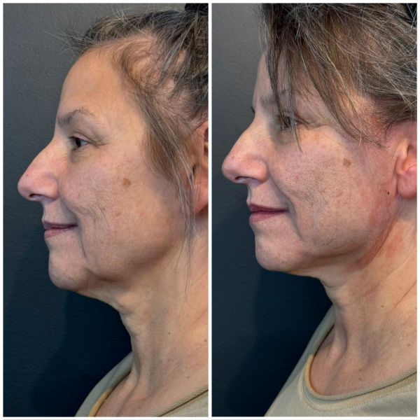 Emerge Aesthetics Before & After Threads Cheek Lift and Neck Lift