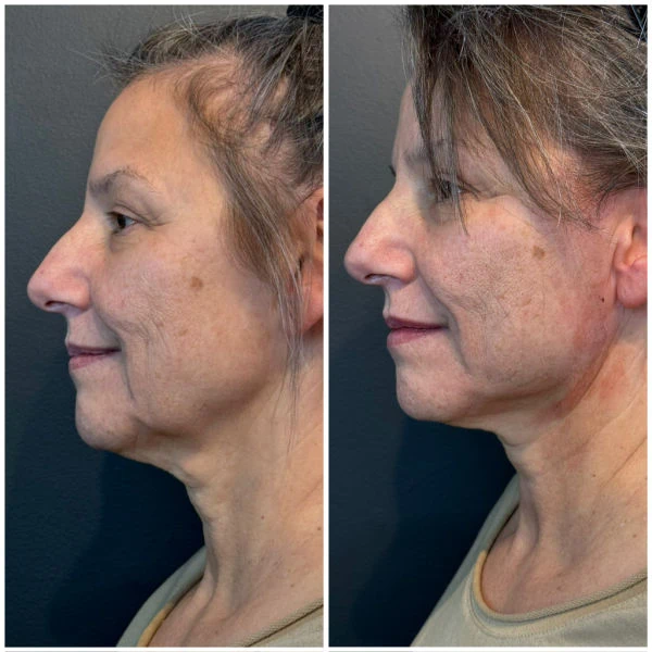 Emerge Aesthetics Before & After Threads Cheek Lift and Neck Lift