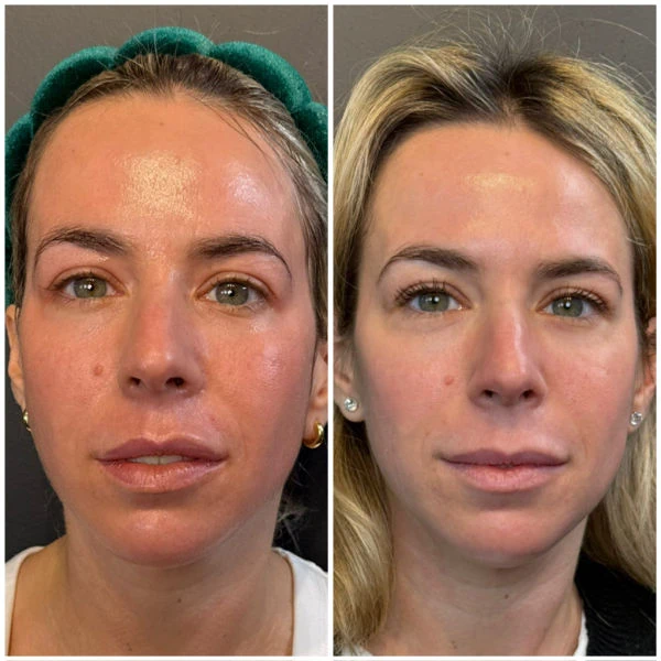 Emerge Aesthetics Before & After CO2 Laser