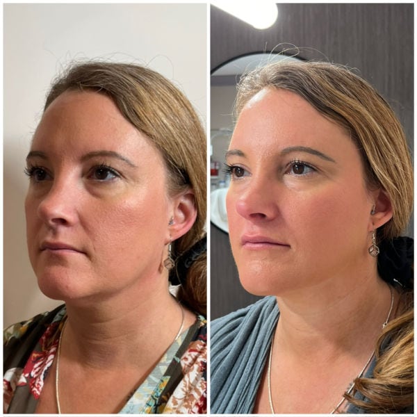 Emerge Aesthetics Before & After full face neurotox including Nefertiti neck lift, chin and platysma including upper face, jawline and cheek filler