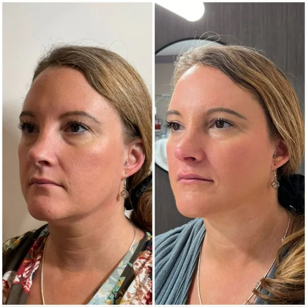 Emerge Aesthetics Before & After full face neurotox including Nefertiti neck lift, chin and platysma including upper face, jawline and cheek filler