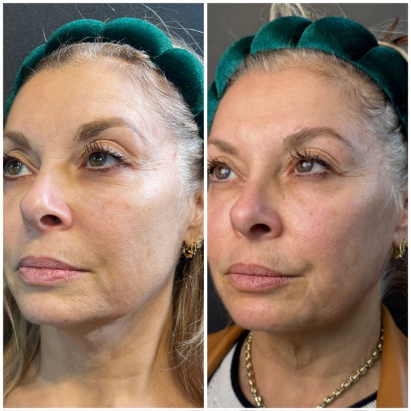 Emerge Aesthetics Before & After 5 vector cheek lift with PDO threads and jawline filler