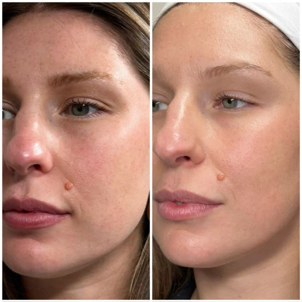 Emerge Aesthetics Before & After Laser