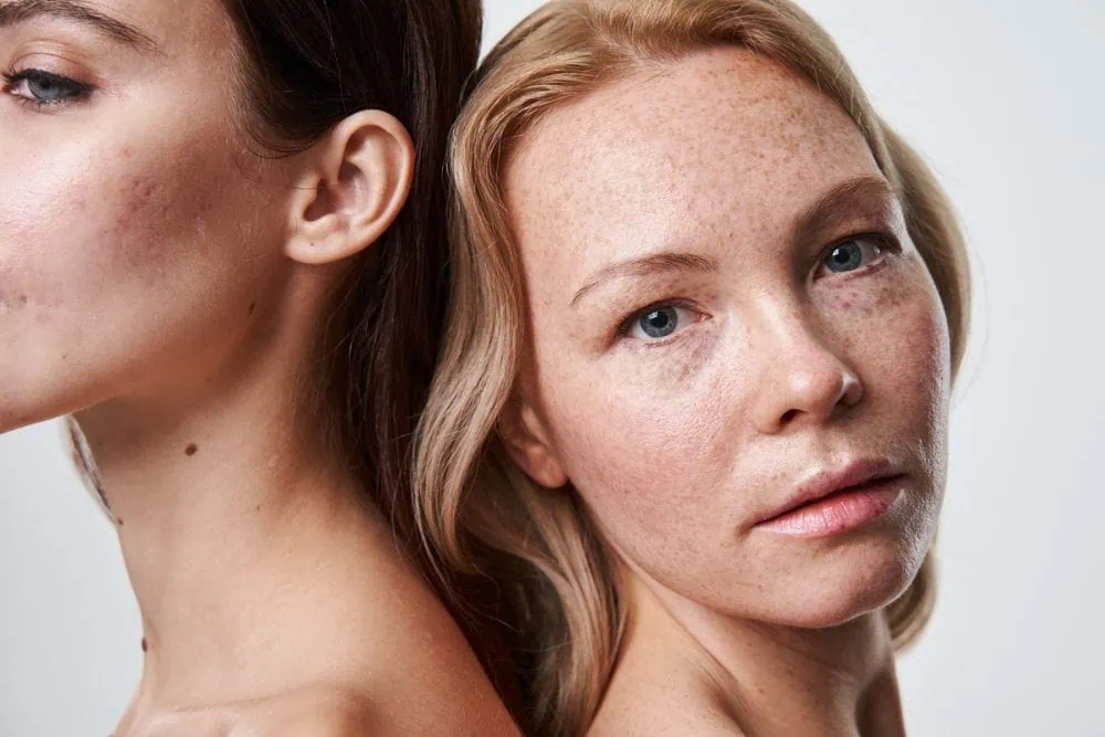 Two Women Laser Treatment at Emerge Aesthetics