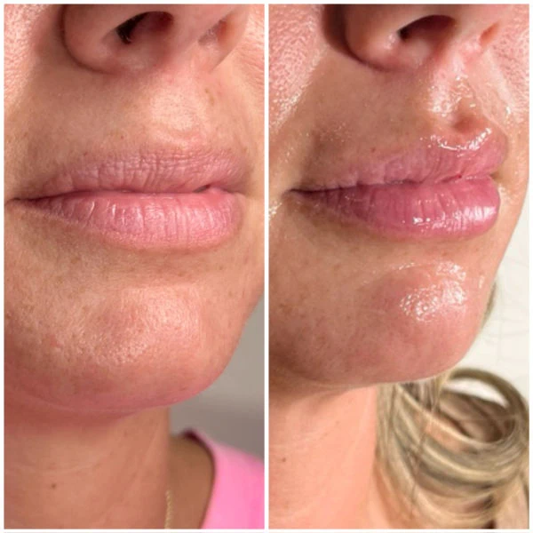 Emerge Aesthetics Before & After Lip filler