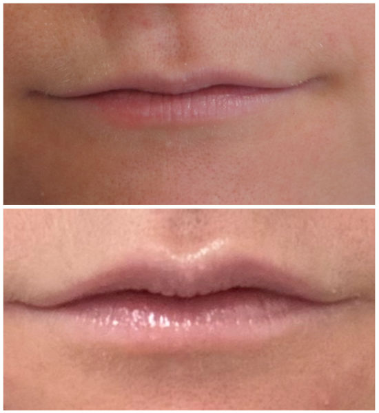 Emerge Aesthetics Before & After Lip Flip