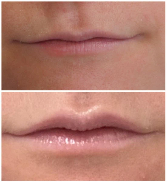 Emerge Aesthetics Before & After Lip Flip