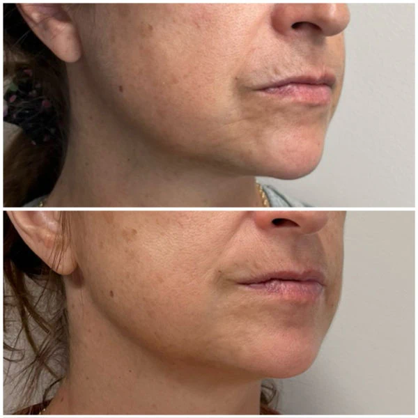 Emerge Aesthetics Before & After lower face Botox