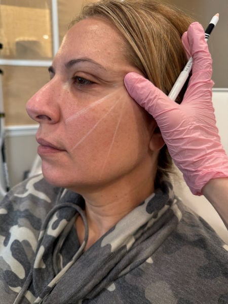 Emerge Aesthetics Marking Patient for Threads