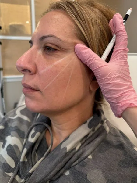 Emerge Aesthetics Marking Patient for Threads