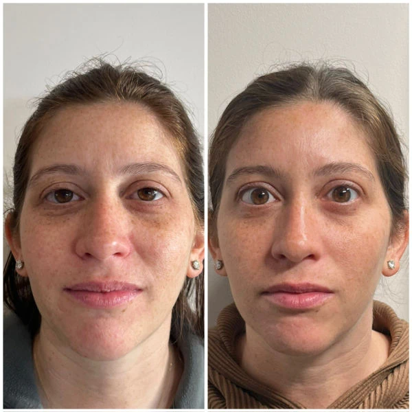 Emerge Aesthetics Before & After Micro-needling + PRP and neurotoxin including brow lift