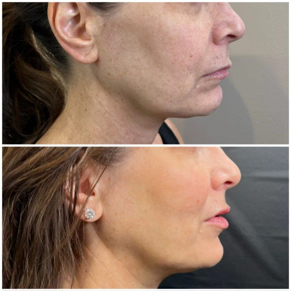 Emerge Aesthetics Before & After threads and jawline Radiesse