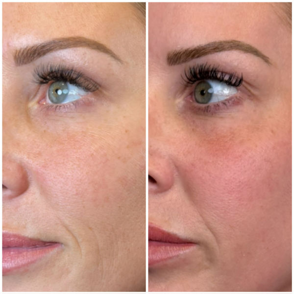 2 sessions CO2 laser at Emerge Aesthetics