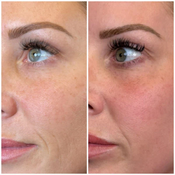 2 sessions CO2 laser at Emerge Aesthetics