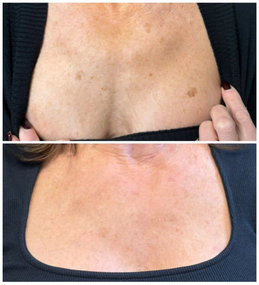 3 sessions CO2 laser for sun spots at Emerge Aesthetics
