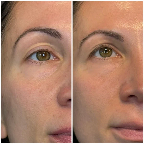 Glow Pin and PRF Injection at Emerge Aesthetics