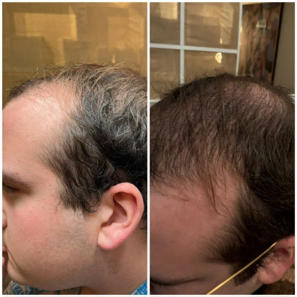 Before and After of hair restoration at Emerge Aesthetics
