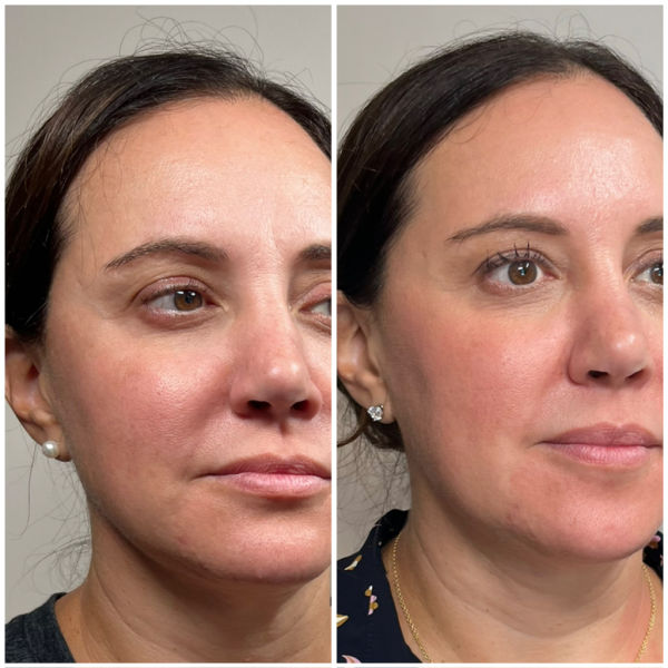 Sculptra before after at Emerge Aesthetics