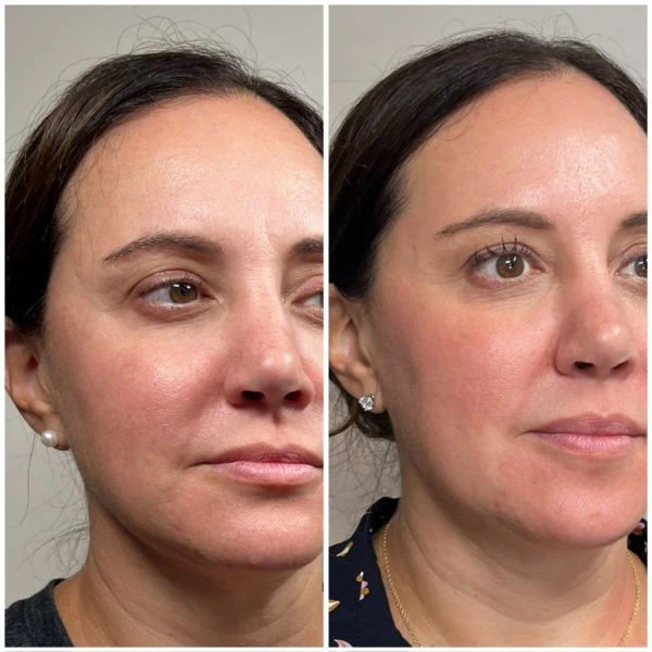 Sculptra before after at Emerge Aesthetics