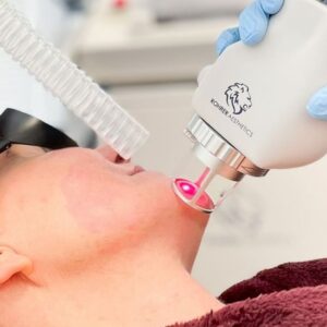 Fractional CO2 Laser Treatment
