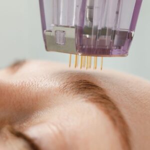 Patient getting microneedling treatment