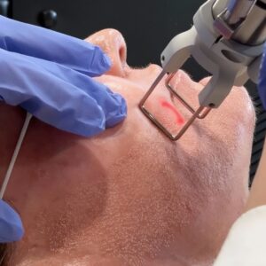 Microneedling vs. Laser: A Complete Guide to Skin Rejuvenation