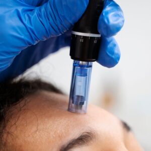What Is Microneedling with PRP