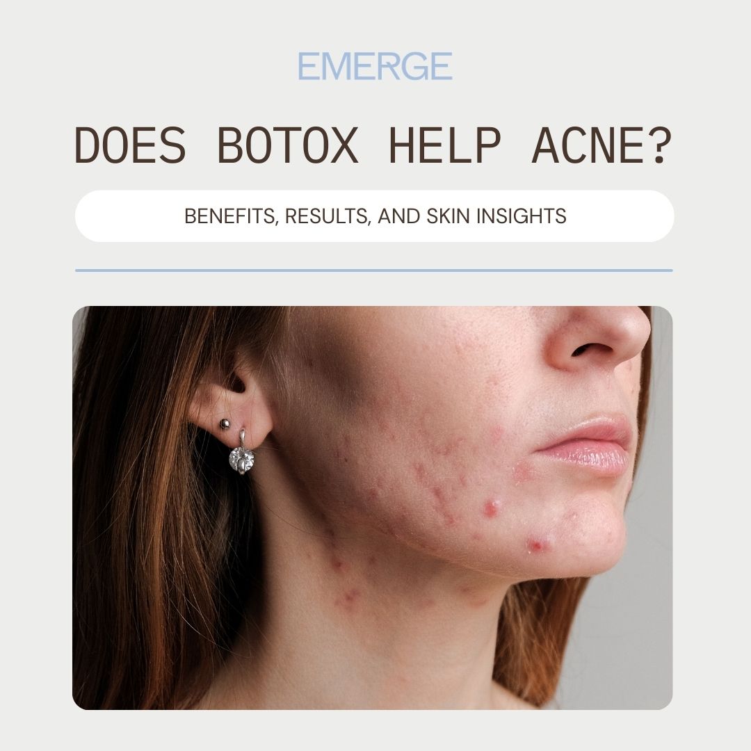Does Botox Help Acne? Benefits, Results, and Skin Insights