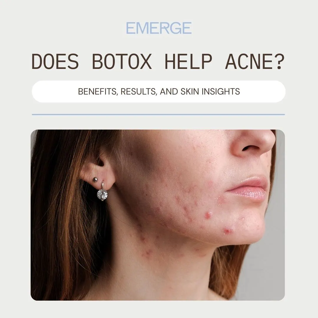 Does Botox Help Acne benefits Does Botox Help Acne? Benefits, Results, and Skin Insights