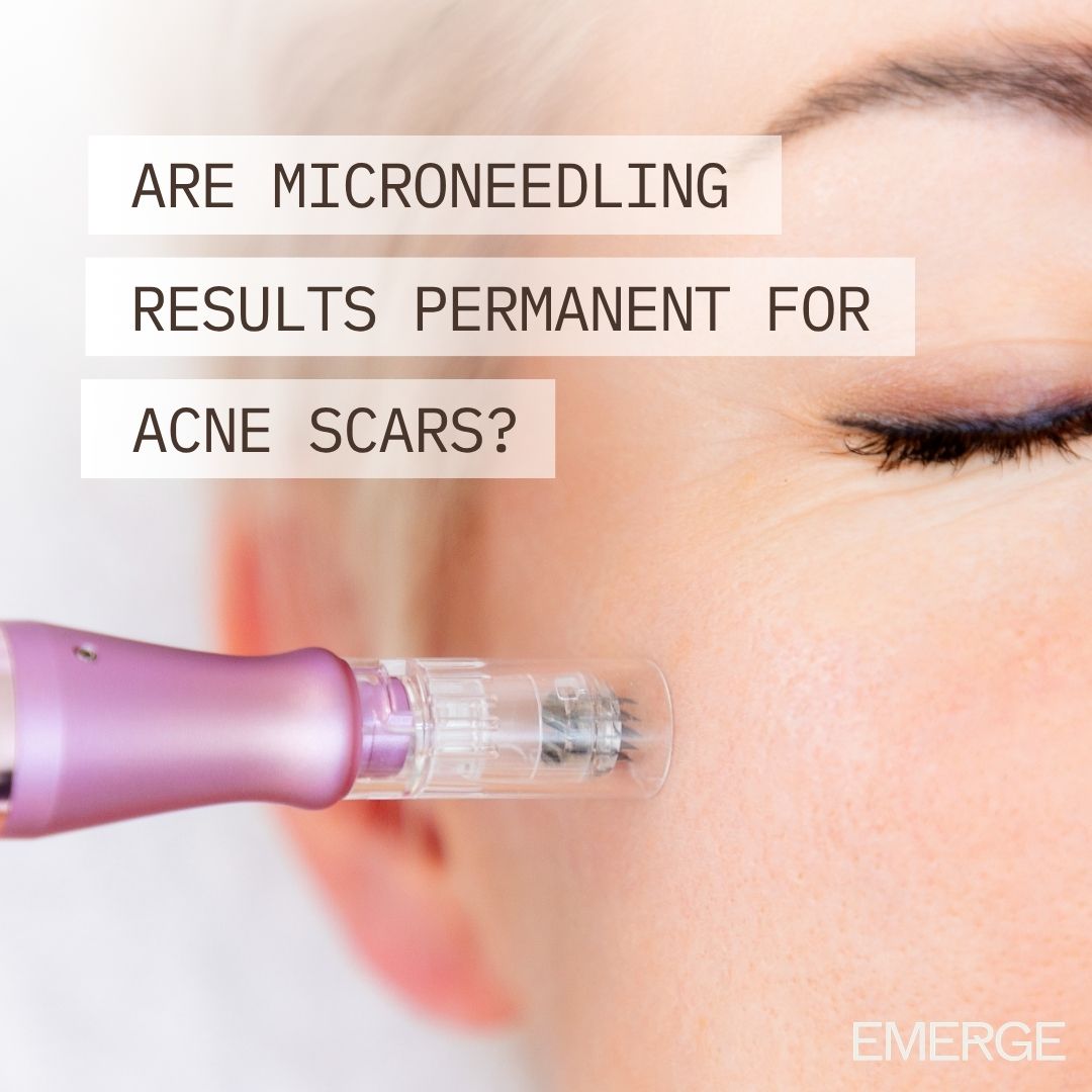 are microneedling results permanent for acne scars?