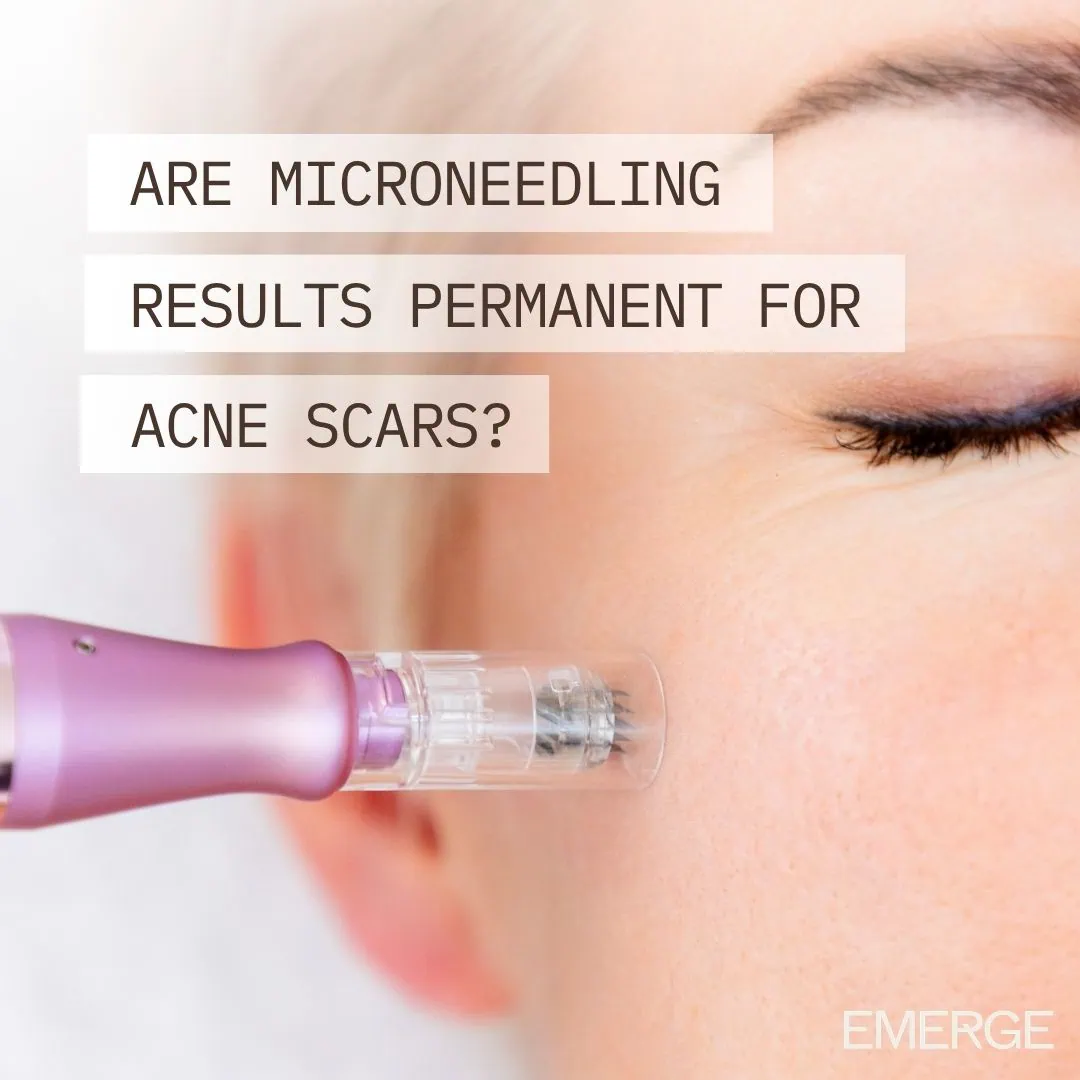 are microneedling results permanent for acne scars are microneedling results permanent for acne scars?