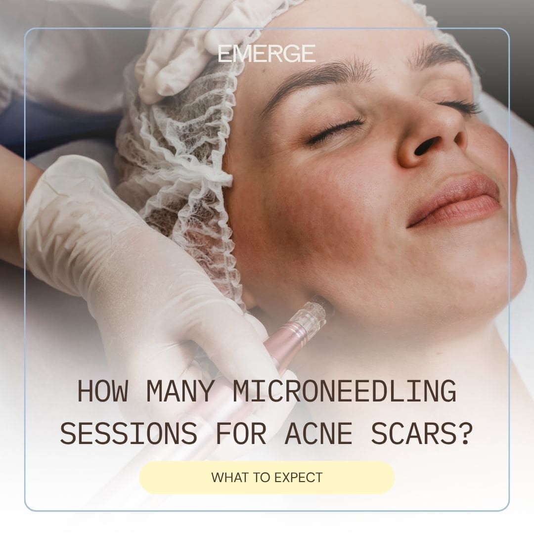 how many microneedling sessions for acne scars?