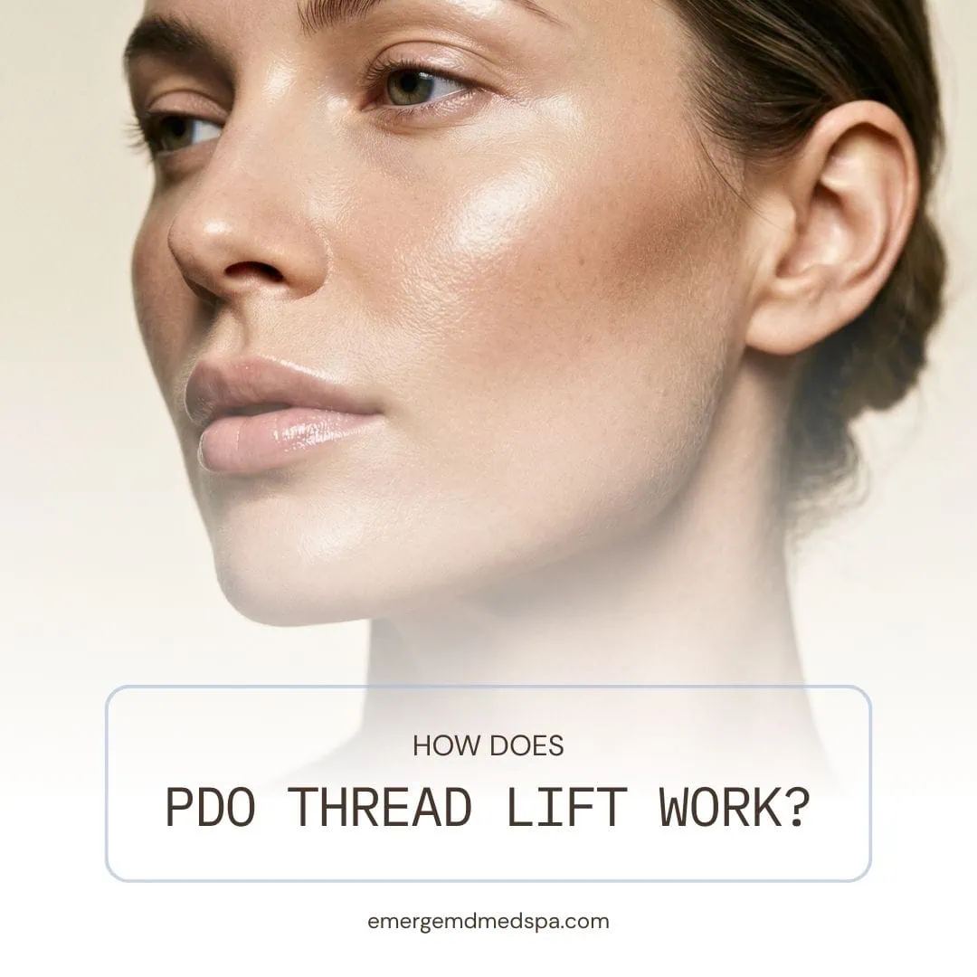 3 | Emerge Aesthetics by Dr. Rochelle Kling MD How Does PDO Thread Lift Work