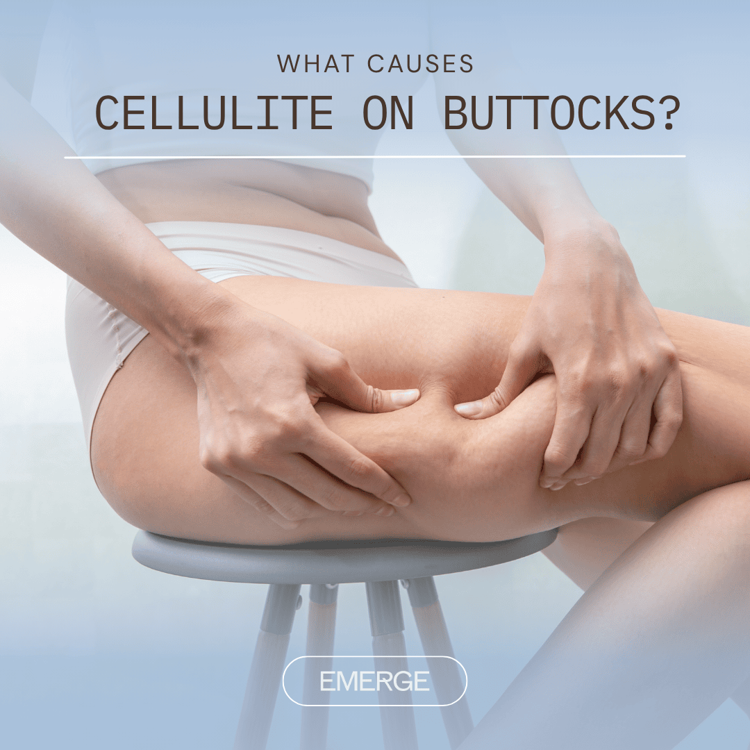 What Causes Cellulite on Buttocks