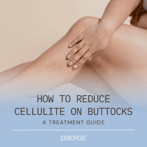 How to Reduce Cellulite on Buttocks: A Treatment Guide