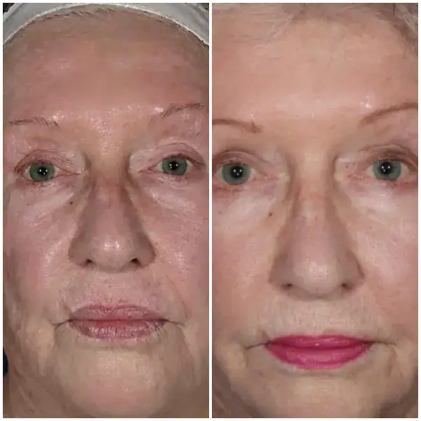 tightening-before-after-1