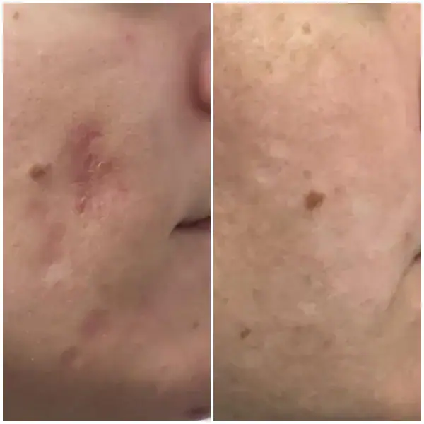 1 month post 3 treatments