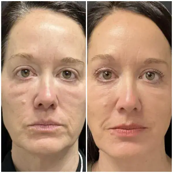 tightening-before-after-11