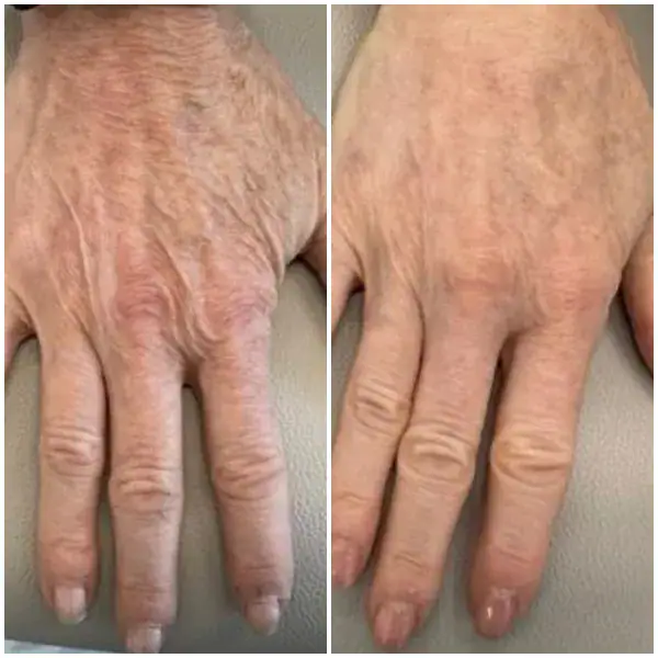 tightening-before-after-12