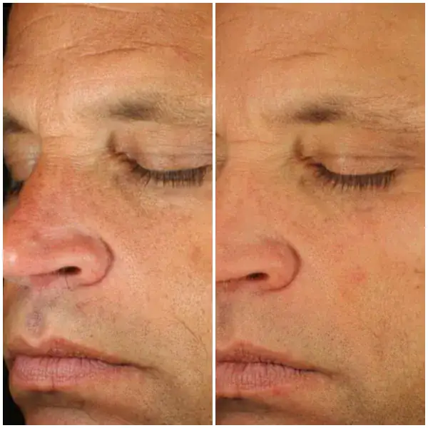 tightening-before-after-14