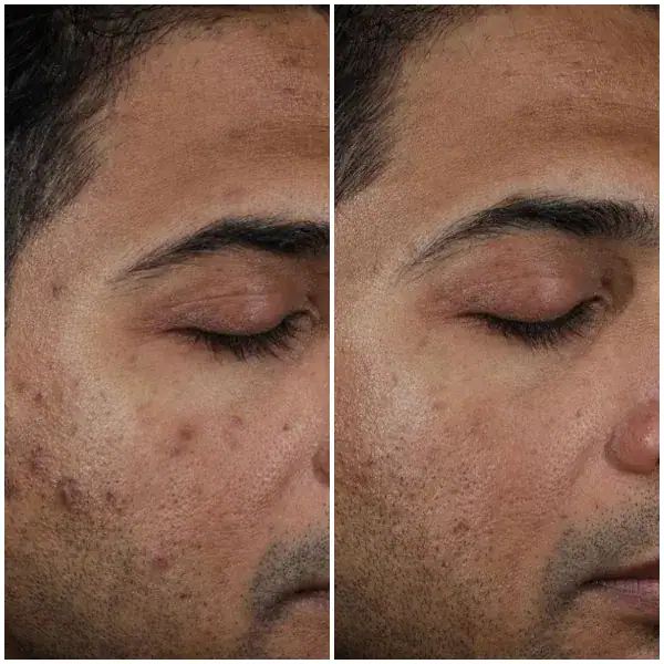 tightening-before-after-15