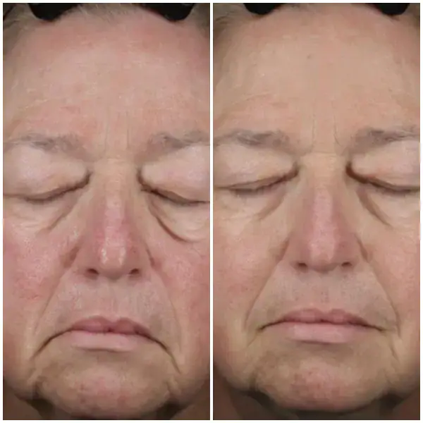 3 months post 1 treatment