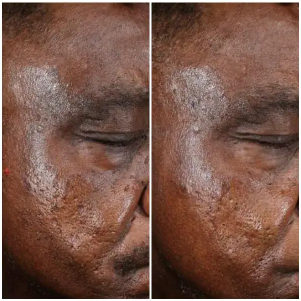 tightening-before-after-3
