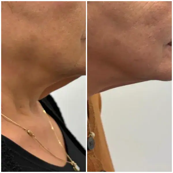 tightening-before-after-4
