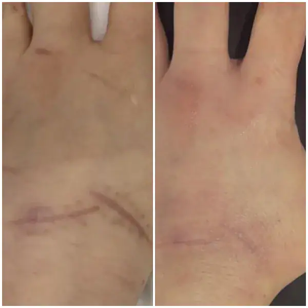 tightening-before-after-5